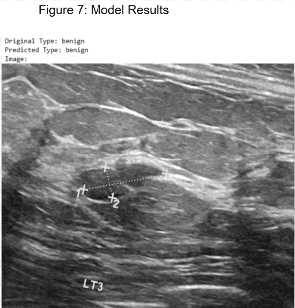 Breast Cancer Detection and Segmentation